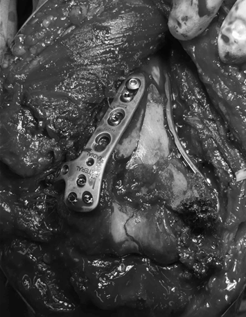 부산골절병원 팔꿈치 뼈가 산산이 부서졌다면 뼈를 다시 맞추는 것부터 시작 > 특수수술 케이스 | 부산 거인병원